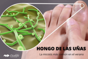 Lee más sobre el artículo Hongo de las uñas, la micosis más común en el verano